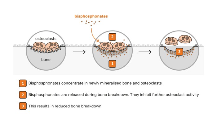 Bisphosphonates